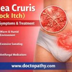 Tinea Cruris Causes Symptoms Treatment