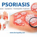 PSORIASIS Causes • Symptoms • Homeopathic Treatment