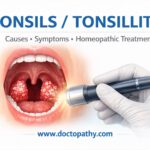 TONSILS / TONSILLITIS Causes • Symptoms • Homeopathic Treatment