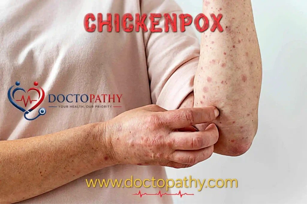 Chickenpox (Varicella): Symptoms, Causes, Prevention & Homeopathic Treatment